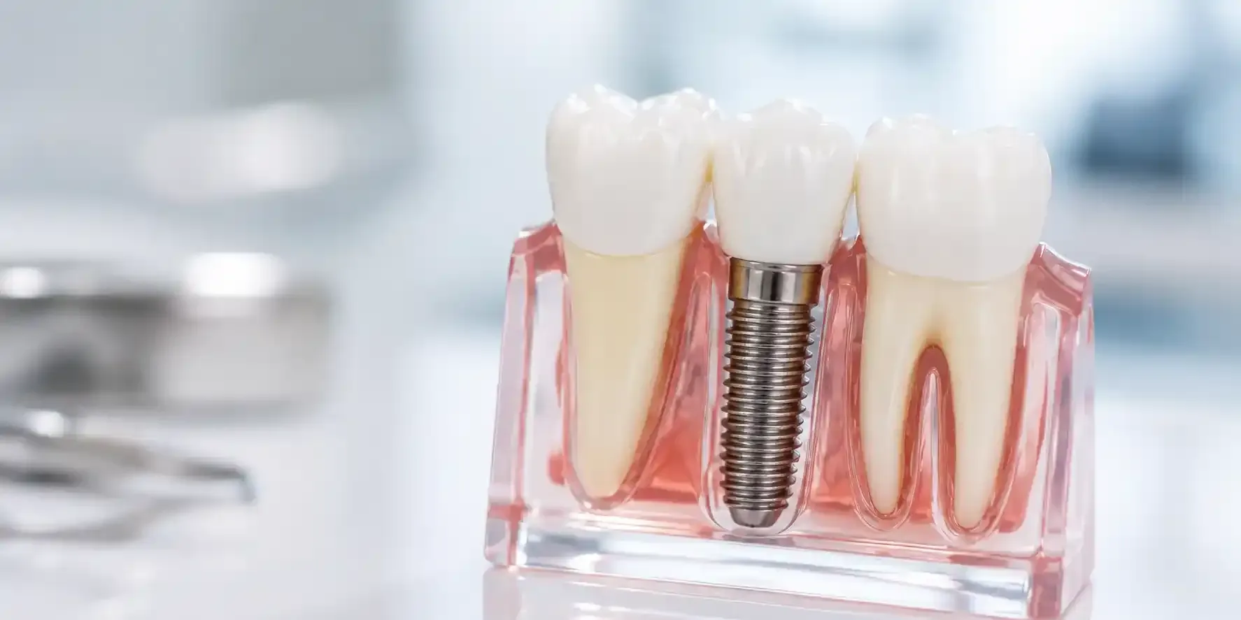 Implantes Dentários
